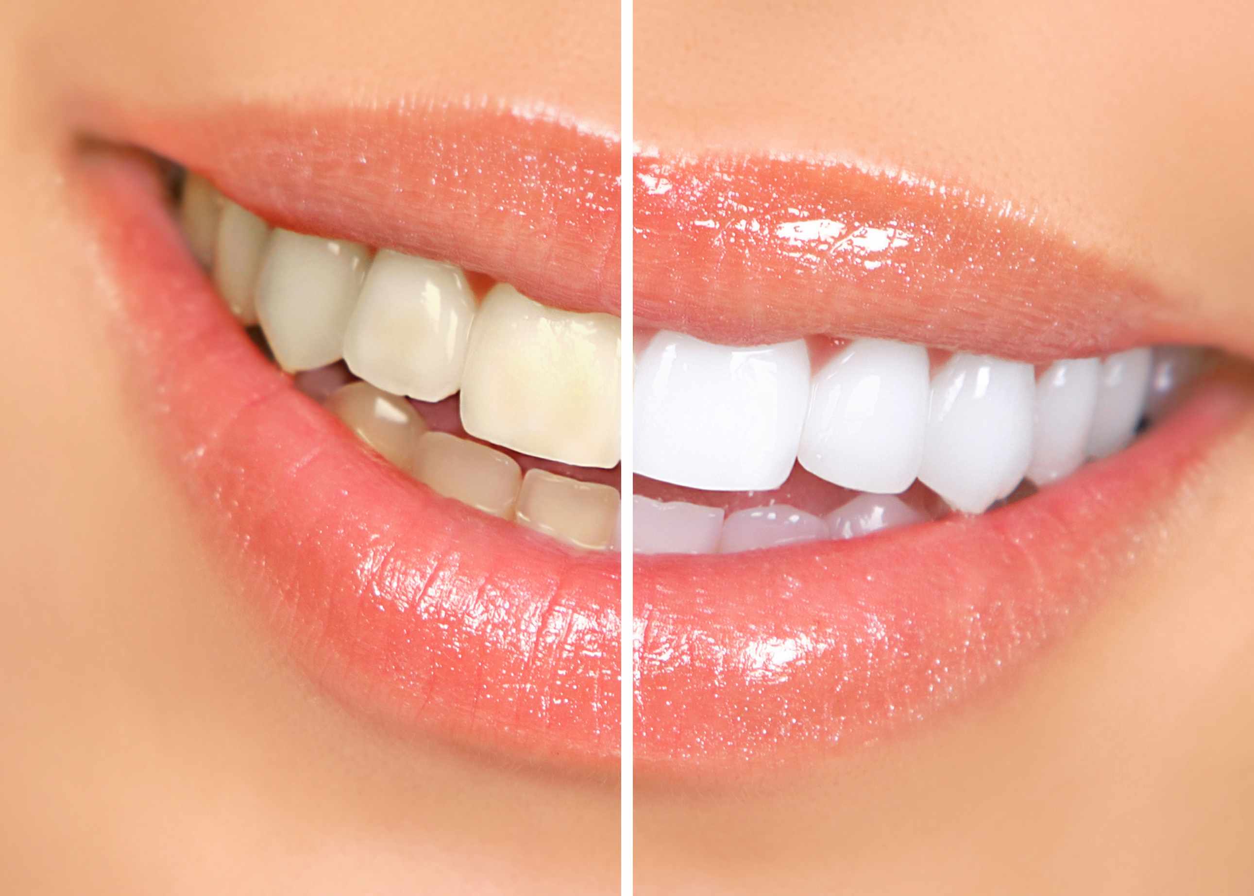 همه آنچه در مورد سفید کردن یا بلیچینگ دندان لازم است بدانید