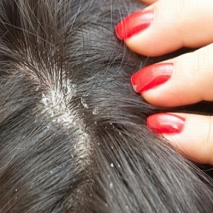 درمانهای خانگی شوره ی موی سر کدامند؟