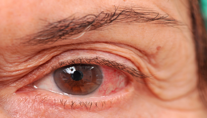 گلوکوم حاد زاویه بسته Acute Angle Closure Glaucoma Deasease