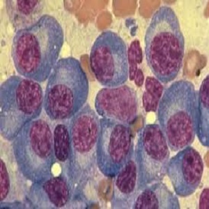 مالیتپل میلوما یا سرطان سلول‌های پلاسما
