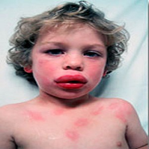 آلرژی بادام زمینی در کودکان