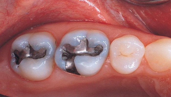 آمالگام دندانی ماده ای سمی در دهان