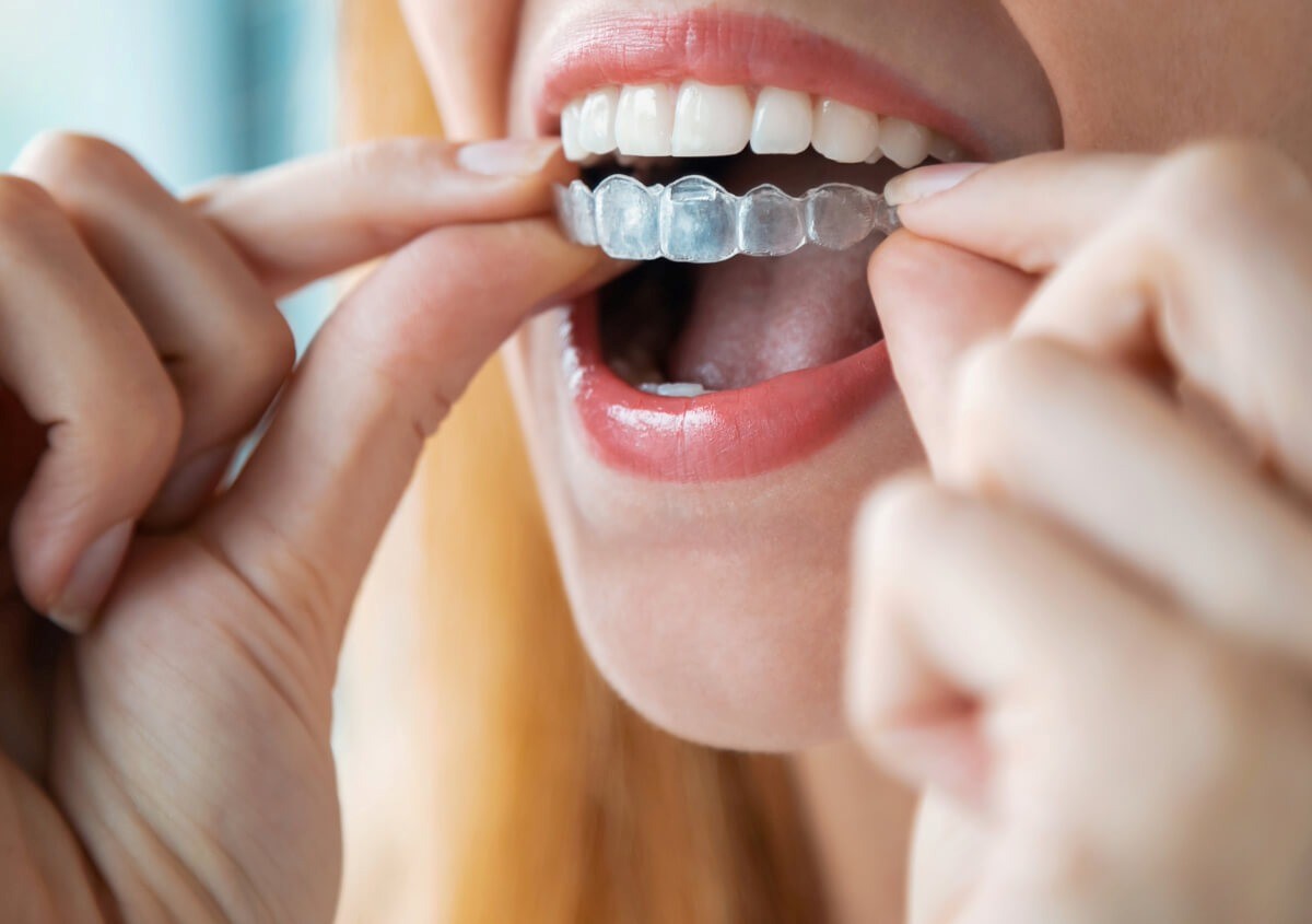 چرا ارتودنسی شفاف به عنوان محبوب‌ ترین روش جدید ارتودنسی شناخته می‌ شود؟