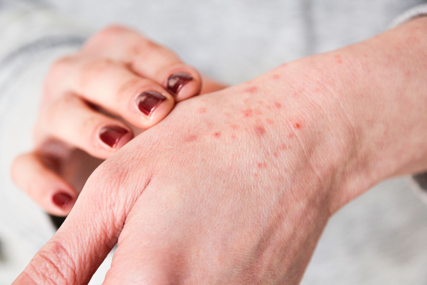کدام مشکلات پوستی نیاز به مراجعه به دکتر پوست دارند؟
