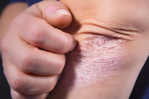 6 روش برای خارش پوست ناشی از پسوریازیس