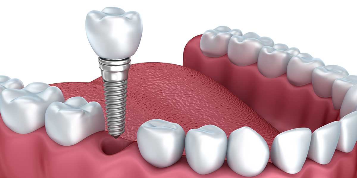 بعد از کاشت یا ایمپلنت دندان چه مراقبت هایی لازم است؟