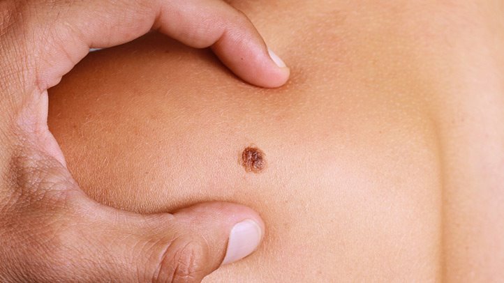 ملانوم یا تومور بدخیم پوستی را می شناسید؟