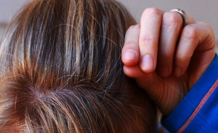 علل و درمان اختلال کندن مو (تریکوتیلومانیا) چیست؟