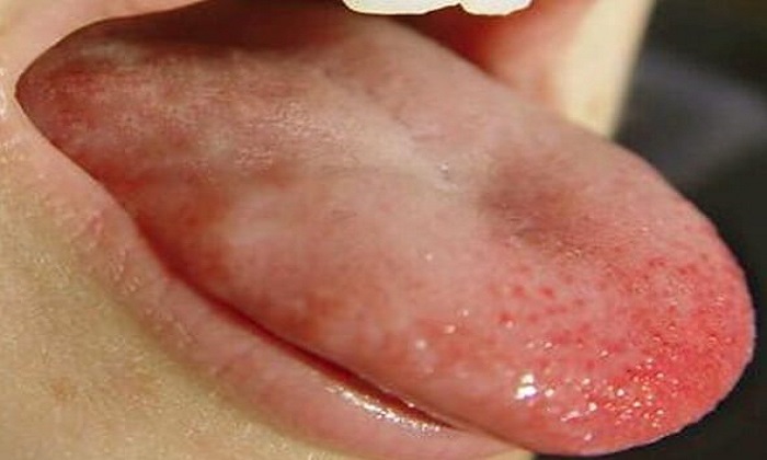 درمان سوختگی و تاول زبان و دهان
