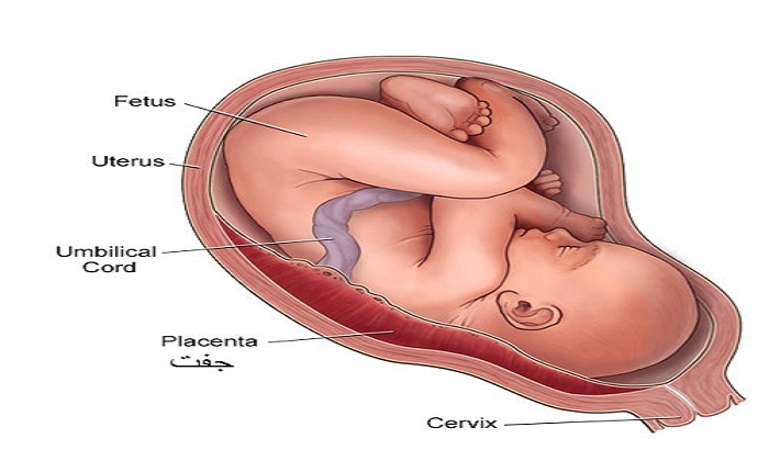 جفت سرراهی عامل خونریزی سه ماهه سوم حاملگی