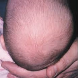 ریزش مو در دوران نوزادی