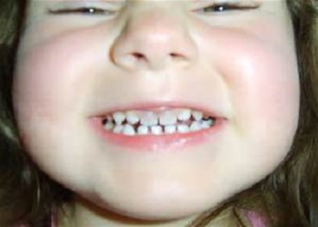 جلوگیری ازبروز لکه های دندانی