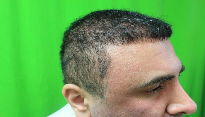 کاشت مو پس از سوختگی امکان پذیر است