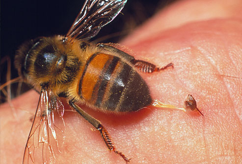 فیلم چگونه زنبورگزیدگی را درمان کنیم؟