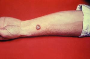 سیاه زخم پوست Anthrax Skin