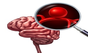 پزشک چگونه آنوریسم مغزی را تشخیص میدهد؟