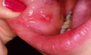 زخم دهان به چه دلیلی ایجاد می شود؟