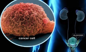 سرطان مثانه، علائم، عوامل و درمان