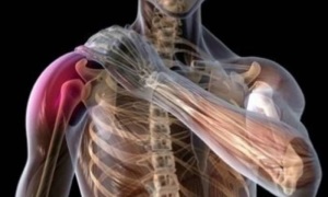 پزشک چگونه آسیب عصب شبکه بازویی را تشخیص میدهد؟