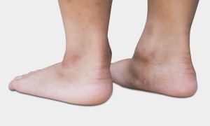 پادکست دکترهمه: درمان کف پای صاف در کودک