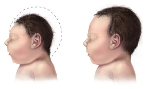 پادکست دکترهمه: راههای پیشگیری از میکروسفالی یا کوچکی سر نوزاد