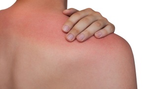 آفتاب سوختگی چگونه درمان می شود؟