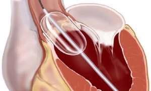 مراقبت های بعد از والوولوپلاستی یا عمل باز کردن تنگی دریچه قلب با بالون