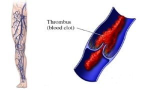 علایم و درمان ترومبوفلبیت یا ترومبوز ورید های عمقی
