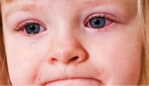 دلایل قرمزی چشم نوزادان وکودکان