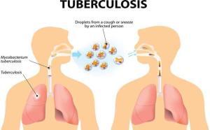 بیماری سل یا توبرکلوزیس چیست؟