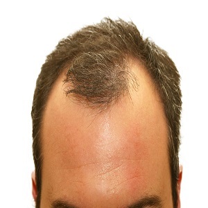 ریزش موی مردان قابل پیشگیری است؟