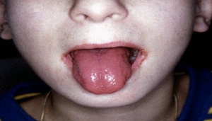 بیماری کاوازاکی در کودکان چیست