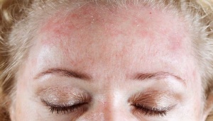 مشکلات پوست و مو در بیماری تیرویید