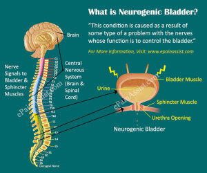 مثانه عصبی یا مثانه نوروژنیک چیست؟